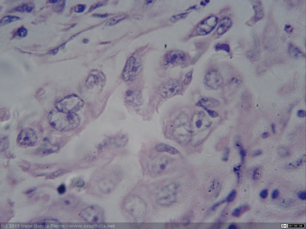 Células humanas deformes a causa de un cáncer de pulmón